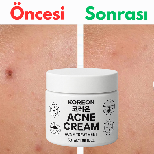 Koreon Acne Cream – Akne ve Sivilce Kremi